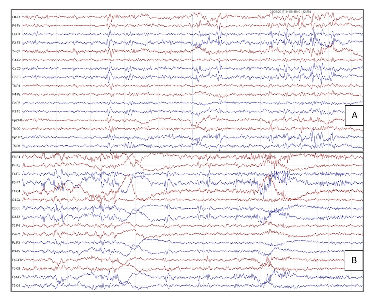 EpilepsiaOpen's tweet photo. Refining the electro-clinical spectrum of NPRL3-related epilepsy: a novel multiplex family and literature review
https://t.co/PyMOs8thZG
#NPRL3 #epilepsy #focalseizures #frontallobe #focalcorticaldysplasia #FCD #epilepsy #ILAE #OpenAccess @IlaeWeb @epilepsiaopen @WileyNeuro https://t.co/1PWxNsliAR