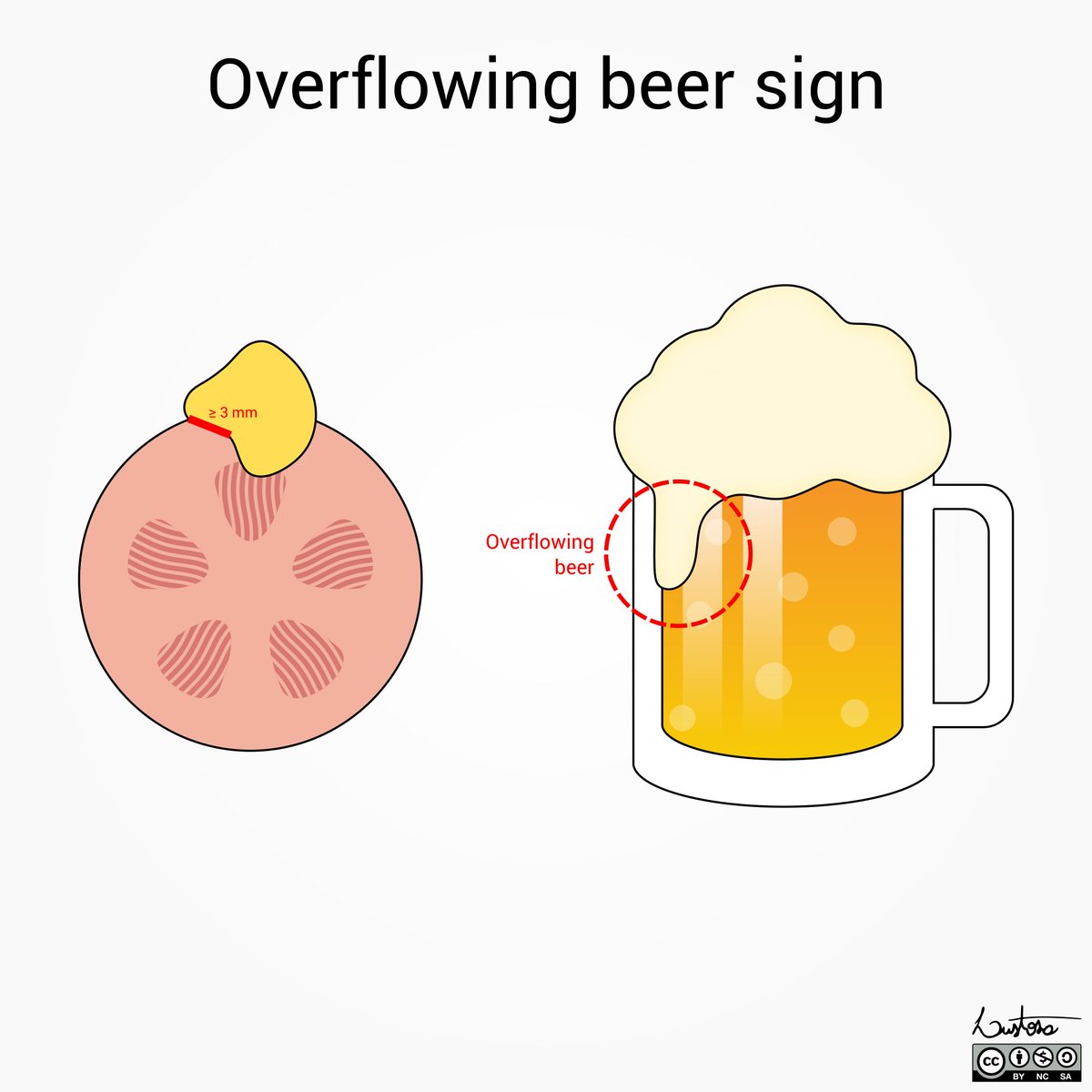 DrLeoLustosa's tweet photo. 🍺 Overflowing beer sign

Illustrations made for the renal imaging workshop on #Radiopaedia2023

Thanks for the invitation to draw these @DrVikasShah and @JosephMullineux 

They were really fun to make 🍻 https://t.co/xkvcK8GJqt
