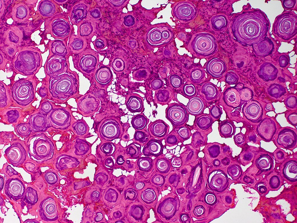 Our favorite Directory image of the week is from Sofia Liou, M.D. @sofialioumd
Subspecialty: Neuropathology
Diagnosis: Psammomatous meningioma
Dr. Liou's profile: pathologyoutlines.com/directory/sofi…

#directory #profile #pathology #neuropath #pathologyoutlines #ImageOfTheWeek #PathTwitter