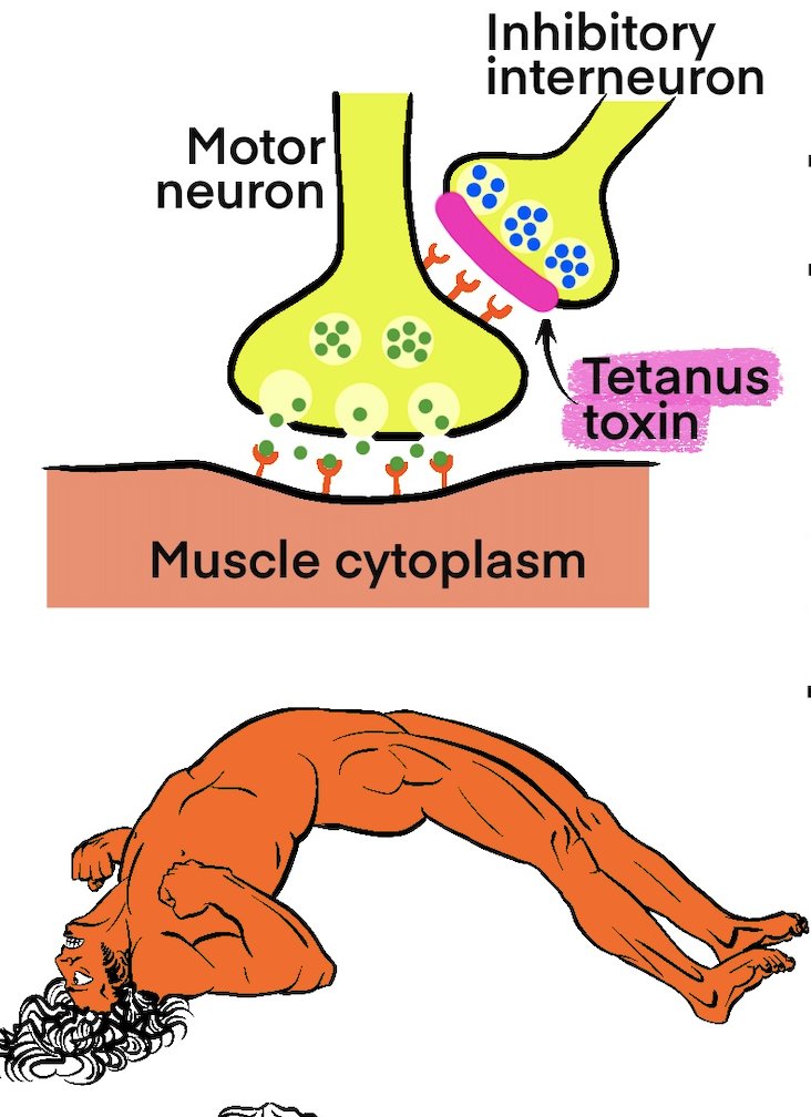 This week's topic: Tetanus. Caused by Clostridium tetani toxin which prevents inhibitory neurotransmission. Generalized tetanus presents with trismus, tachycardia, and muscle contractions. Neonatal tetanus presents with feeding difficulty

#emergencymedicine #EMBoards #MyEMCert