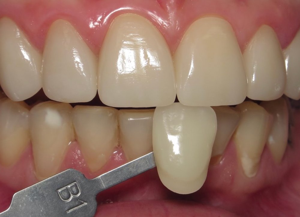 ddldental's tweet photo. When selecting the shade:

// Select the shade before taking the preop scan and prepping. Once the teeth dehydrate, you will not get a reliable shade.

// Take a picture with the shade tab(s) visible, lining up the incisal edge of the tooth with the incisal edge of the shade tab. https://t.co/u3vVxC7x8g