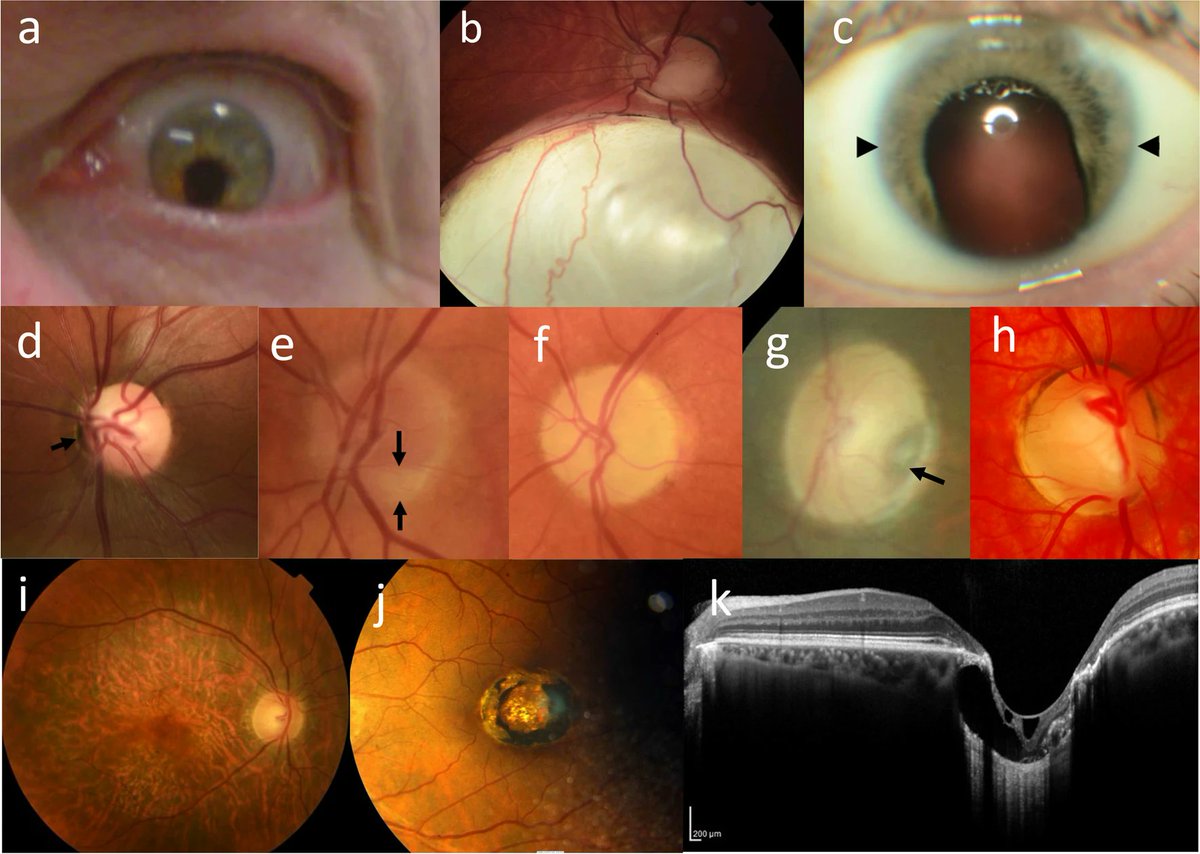 CAKUT are among the most common birth defects worldwide & a major cause of kidney failure in children. Read this review of diseases associated w/the Genomics England CAKUT-associated gene panel for ocular anomalies. #OpenAccess link.springer.com/article/10.100…