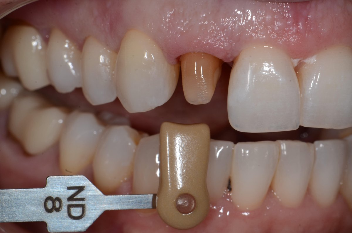ddldental's tweet photo. Always include a stump shade photo if the prep is darker than the surrounding teeth.

https://t.co/EqLEy4K0Ju

#digitaldentistry https://t.co/Qb570pyNep