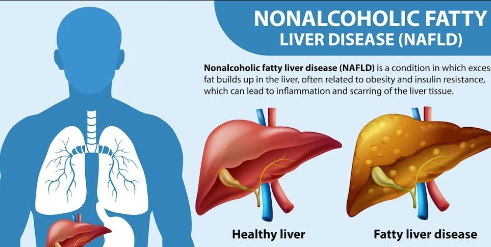 healthybell4u's tweet photo. Nonalcoholic fatty liver disease (NAFLD) is a prevalent condition that can have serious implications for liver health.
https://t.co/OATpOCENMU

#FattyLiver #Liver #nonalcoholic #NAFLD #HealthyBel #LiverHealth #unitedstatesofamerica https://t.co/y6pSSzs5MM