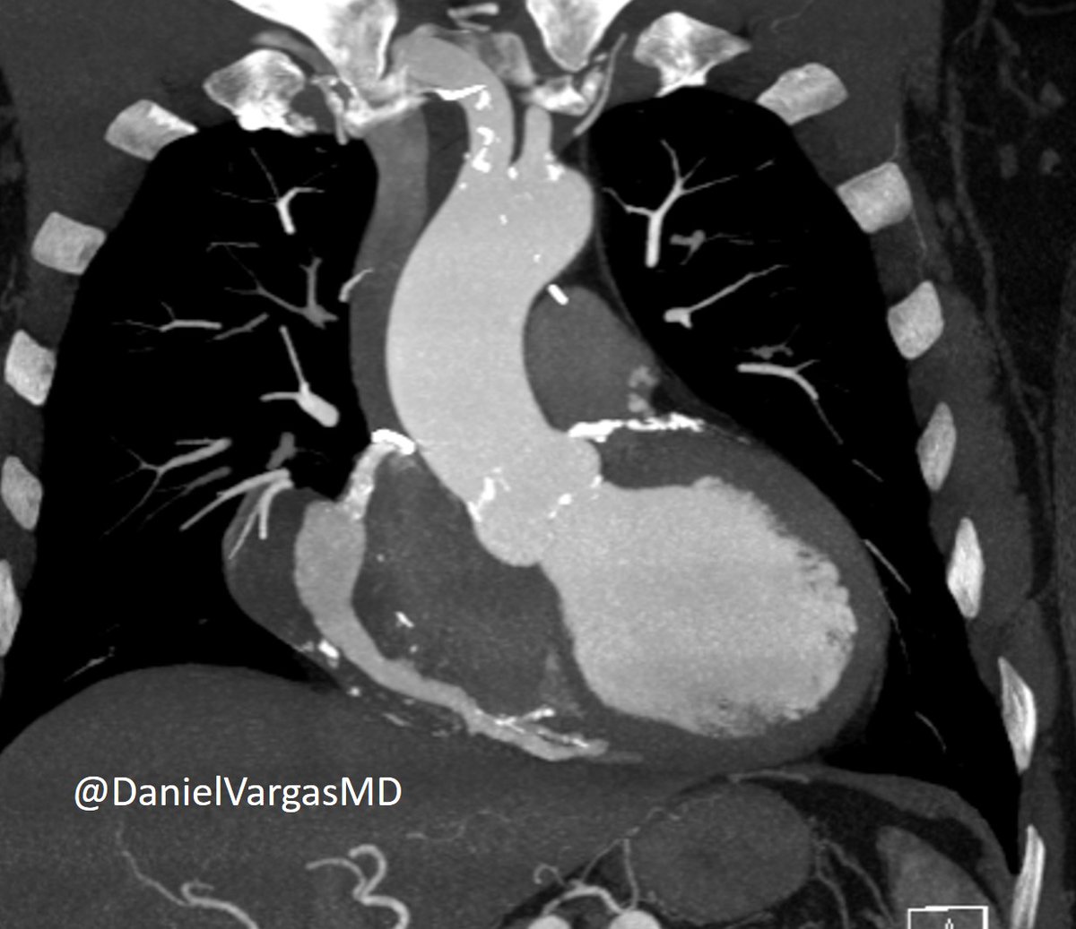 DanielVargasMD's tweet photo. 🫀Partially thrombosed Saphenous Venous Graft Aneurysm (SVG to PDA):

🔸Uncommon complication of SVGs <0.1%
🔸Late (~10-15y)
🔸Complications include rupture, compression of structures, fistula and MI

@NASCISociety @KateHanneman @blanca_domenech
@erica_tirr @Heart_SCCT #yesCCT https://t.co/KpVyZ56bXU