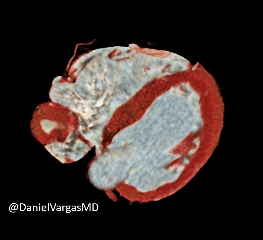 Daniel Vargas, MD (@danielvargasmd) on Twitter photo 🫀Partially thrombosed Saphenous Venous Graft Aneurysm (SVG to PDA):
🔸Uncommon complication of SVGs <0.1%
🔸Late (~10-15y)
🔸Complications include rupture, compression of structures, fistula and MI
<a href="/NASCISociety/">NASCI</a> <a href="/KateHanneman/">Kate Hanneman</a> <a href="/blanca_domenech/">Blanca Domenech-Ximenos</a>
<a href="/erica_tirr/">Erica Tirr (@ericatirr.bsky.social)</a> <a href="/Heart_SCCT/">Heart_SCCT</a> #yesCCT 🫀Partially thrombosed Saphenous Venous Graft Aneurysm (SVG to PDA):
🔸Uncommon complication of SVGs <0.1%
🔸Late (~10-15y)
🔸Complications include rupture, compression of structures, fistula and MI
<a href="/NASCISociety/">NASCI</a> <a href="/KateHanneman/">Kate Hanneman</a> <a href="/blanca_domenech/">Blanca Domenech-Ximenos</a>
<a href="/erica_tirr/">Erica Tirr (@ericatirr.bsky.social)</a> <a href="/Heart_SCCT/">Heart_SCCT</a> #yesCCT