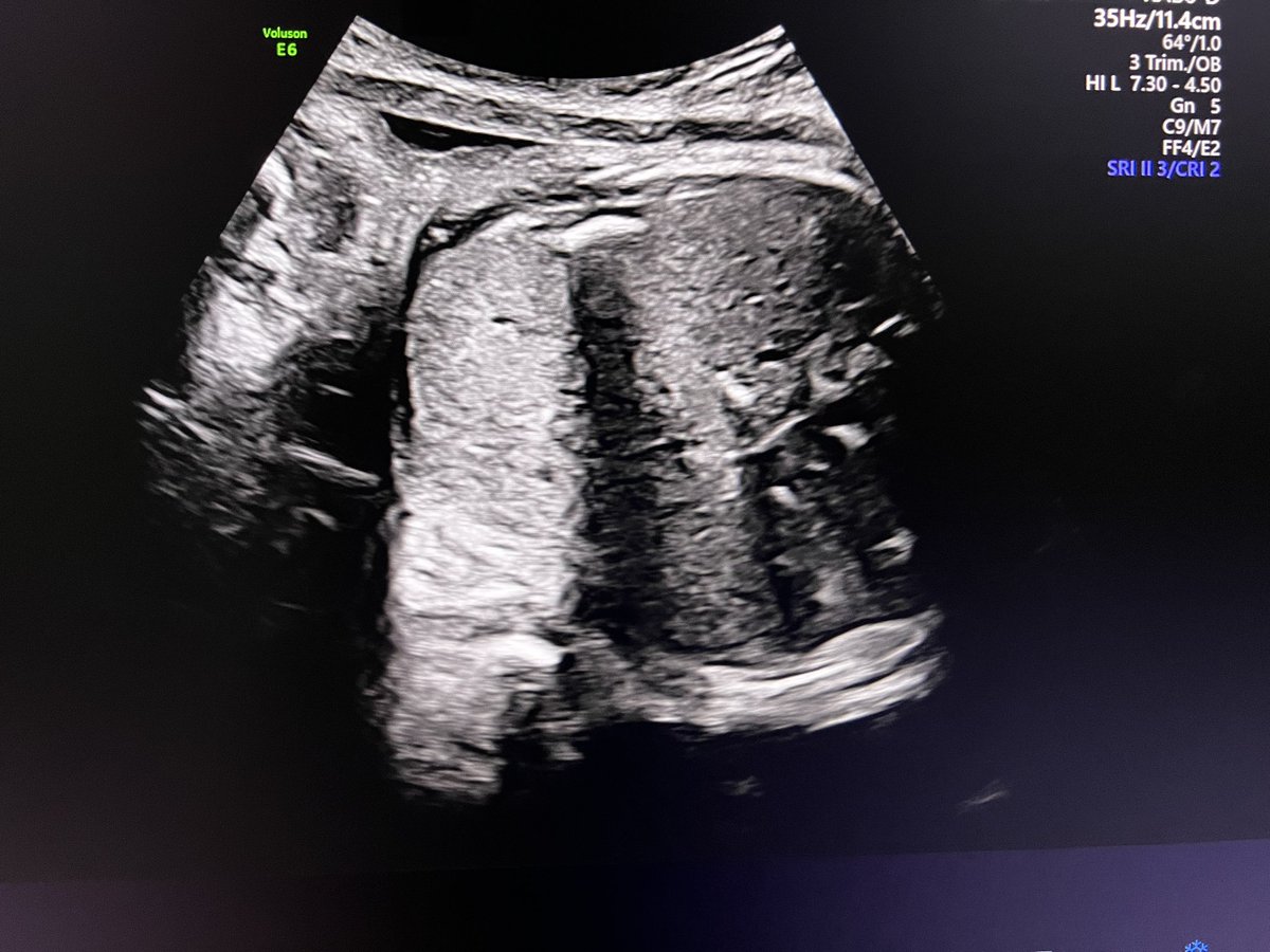 dr_ps1's tweet photo. Fetal liver calcification. Mostly associated with intrauterine infections. Other associations- chromosomal problems. Or even in normal fetus . https://t.co/5S7k97kpws