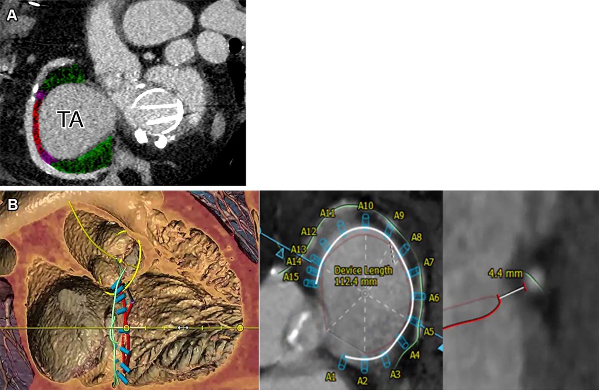 Cardiac CT and MRI have several advantages for comprehensive preprocedure assessment for transcatheter tricuspid valve interventions (TTVIs). Learn about the advantages of each technique and how they complement echocardiography here. bit.ly/44K09fI