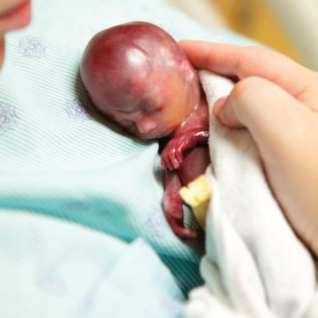 Lexi y Joshua Fretz esperaban con entusiasmo la llegada de un nuevo hijo cuando Lexi experimentó un manchado a las 19 semanas y fue llevada de urgencia a la sala de emergencias.

 Después de aproximadamente una hora de espera, Lexi pudo escuchar los latidos del corazón de su bebé
