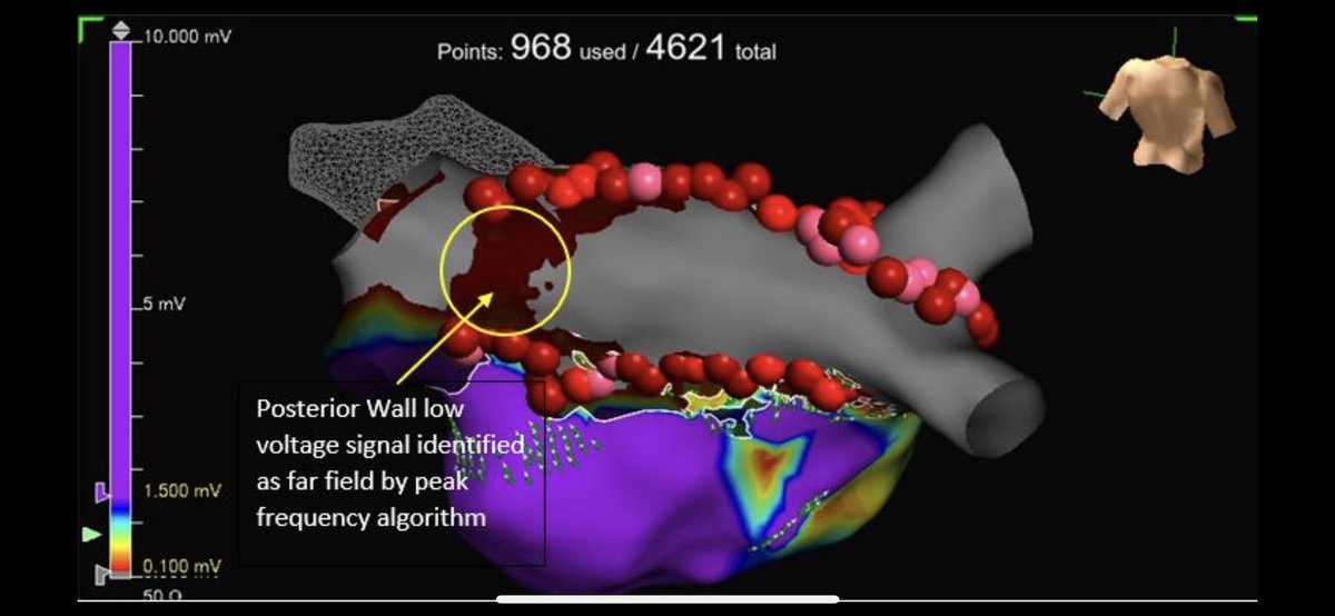 kylem80441's tweet photo. Redo PVI mapped by @nolannagle1 with Dr. Jeffrey Neiger at Advocate Christ Medical Center. HD Grid voltage map identified RSPV/Carina leak. Re-isolated RSPV as well as PW. Far field signal on PW identified with peak frequency and emphasis mapping! https://t.co/4YrzMkNufo