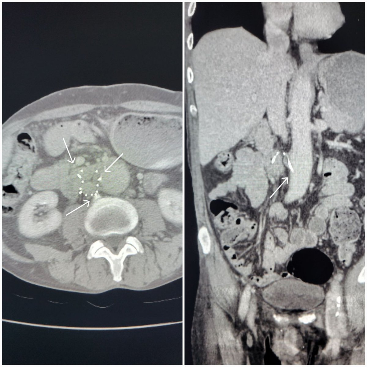 TempleRADs's tweet photo. Patient w/ IVC filter >7 yrs.  Leg protrusion into spine, duodenum, AND aortic wall. No problem for forceps + biceps. Post venogram shows moderate stenosis. Anticoagulation started without issues. Nice work @MarkEdelsteinIR @SLee106. @TempleRadRes @SIR_ECS @SIRRFS #filterout https://t.co/JYoqWa3Se1