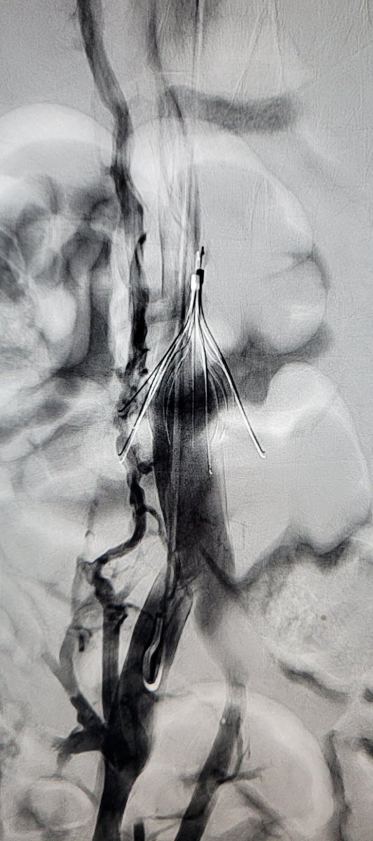TempleRADs's tweet photo. Patient w/ IVC filter >7 yrs.  Leg protrusion into spine, duodenum, AND aortic wall. No problem for forceps + biceps. Post venogram shows moderate stenosis. Anticoagulation started without issues. Nice work @MarkEdelsteinIR @SLee106. @TempleRadRes @SIR_ECS @SIRRFS #filterout https://t.co/JYoqWa3Se1