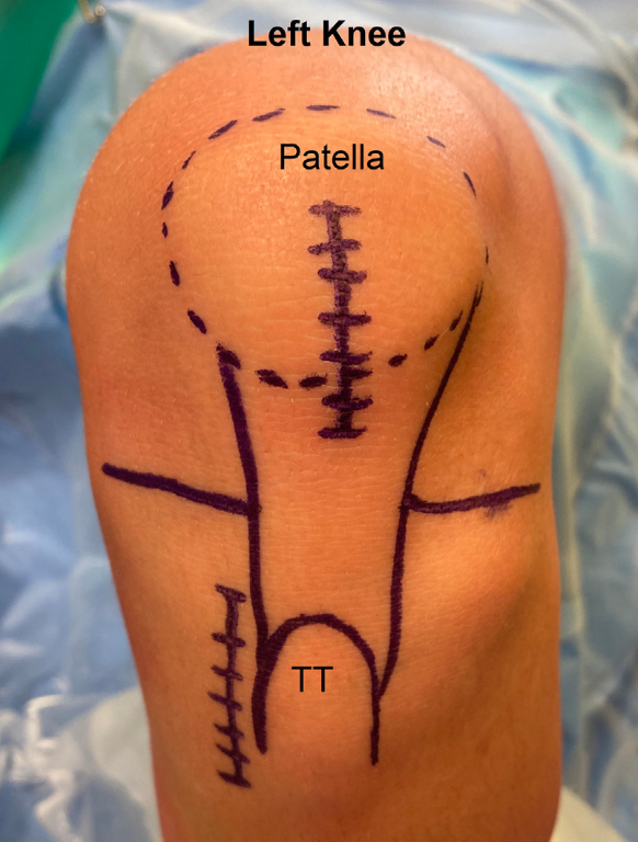 Chris Servant (@chrisservant65) on Twitter photo Bone-patellar tendon-bone autografts can be harvested with relatively low morbidity
gbr01.safelinks.protection.outlook.com/?url=https%3A%…
<a href="/ArthroscopyJ/">Arthroscopy Journal</a>
#kneesurgery #ACL #arthroscopy Bone-patellar tendon-bone autografts can be harvested with relatively low morbidity
gbr01.safelinks.protection.outlook.com/?url=https%3A%…
<a href="/ArthroscopyJ/">Arthroscopy Journal</a>
#kneesurgery #ACL #arthroscopy