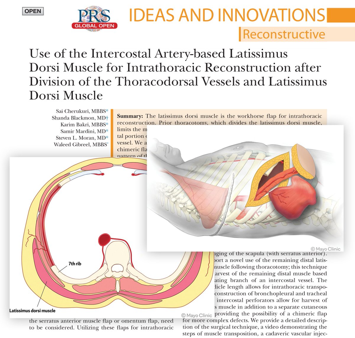 Does prior thoracotomy dividing the latissimus dorsi muscle and thoracodorsal vessels preclude the use of the latissimus dorsi muscle for intrathoracic #reconstruction? Read the article to find out: bit.ly/IntercostalArt…