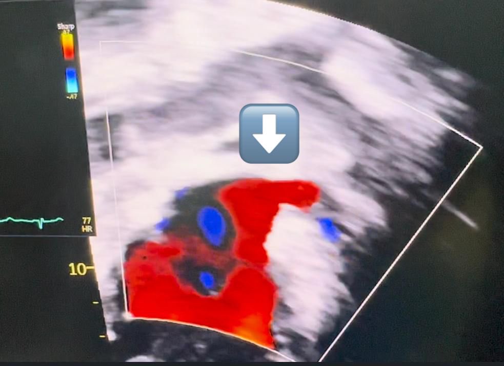 victorbauher's tweet photo. Cirugía ♥️ congénita mínimamente invasiva en
@childrenshospsa @CSRFoundations @CSRHS @CHRISTUSHealth @BCM_Surgery 
Esta vez paciente adulto con retorno venoso anómalo parcial reparado por minitoracotomia anterior izq. Sin circulación extracorpórea. Alta al 2do dia 🏠. https://t.co/d6E1A08ihE