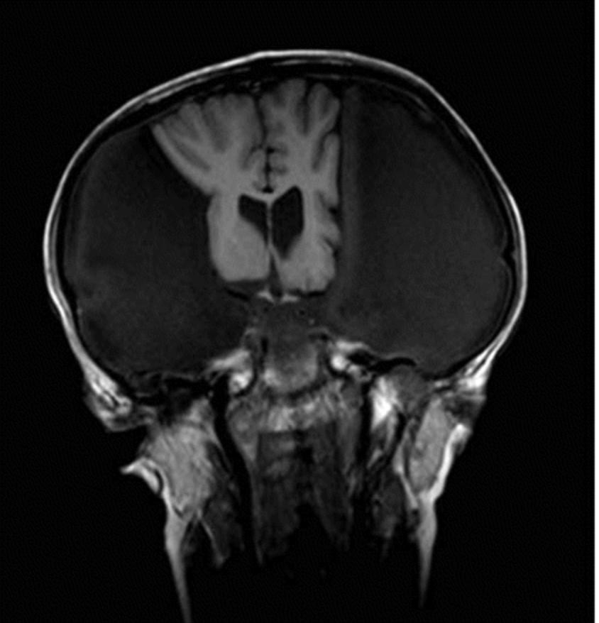 Adolescent with daily, generalized headaches underwent an MRI. Remarkably, her neurological exam was without any deficits. Let's discuss. 🧵