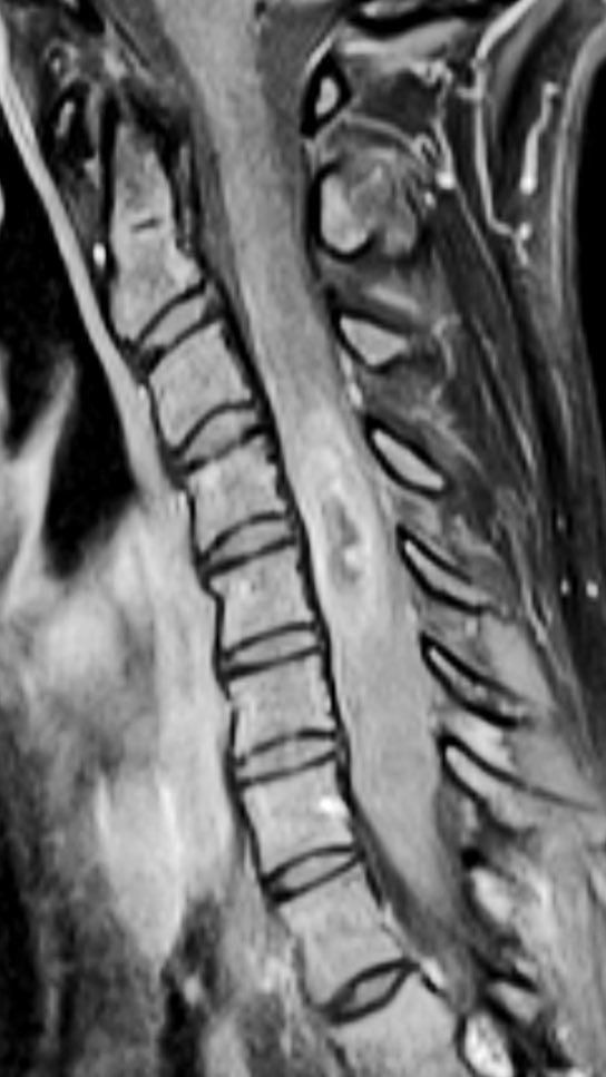 Unneurocx's tweet photo. There are days when I would rather have another specialty #neurosurgery. #virtualspine https://t.co/JrgyE2yyNX