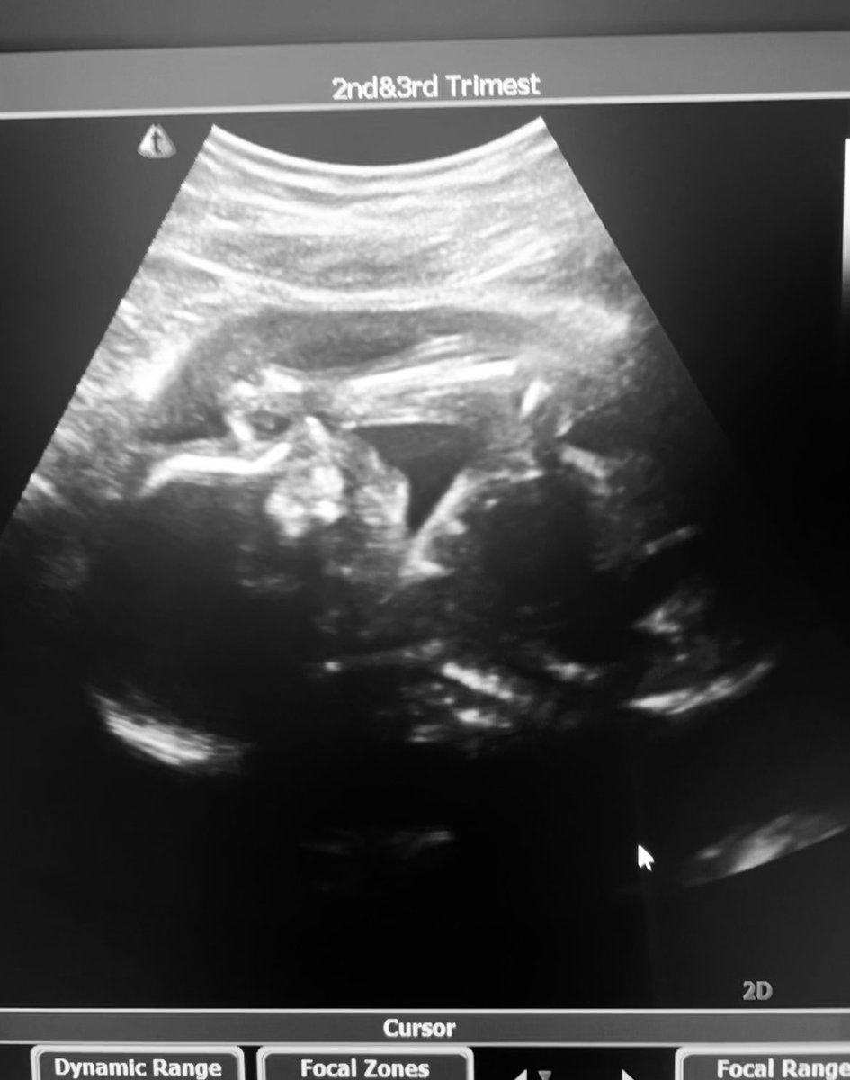 kali_arledge's tweet photo. 24 weeks with baby girl Whitley 💖 https://t.co/qVdbZgYP2b