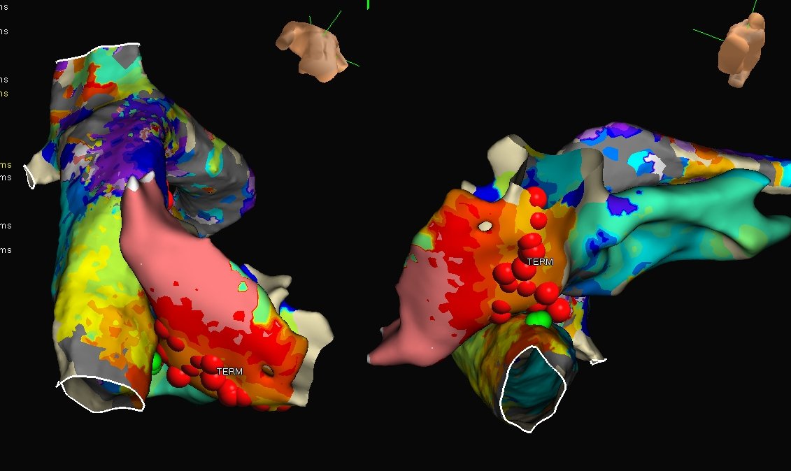 kbarker757's tweet photo. The not so typical...typical flutter. Pt in their 30's. S/P fontan procedure as a child. Presented in a 315ms flutter that was not contained inside the graft. CTI ablation through the graft by @nsp243 and @wynn_hunter

#hdgrid #EPeeps @AbbottCardio https://t.co/O2oruFIQSC