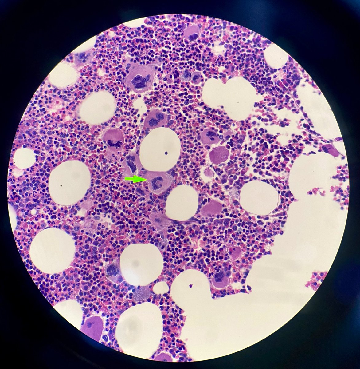 Trombocitemia esencial primaria, megacariocitos con núcleos multilobulados que semejan “asta de ciervo” 🔬
#MorphologyMonday 
#Hematopathology