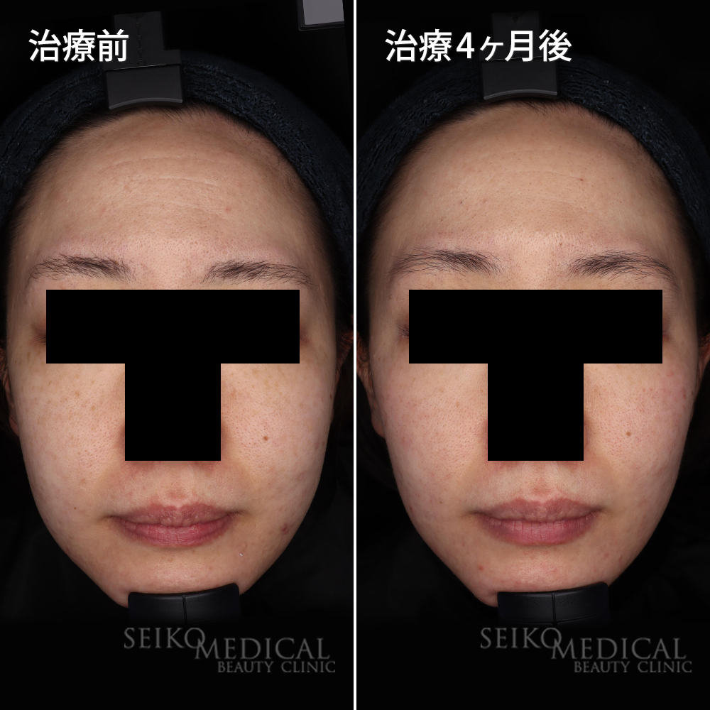 seikomedical's tweet photo. 当院でニキビ治療をしている方で、頬のシミやニキビ痕が気になってきたとのお話でした。
セラピューティックプログラムを行い、4か月の経過写真です。
特におでこのシワの改善が素晴らしいですね。

https://t.co/DdzgCzNRRL
#ゼオスキン #ZOSKIN  #スキンケア  #シワ #セラピューティック https://t.co/HGB5KglLfq