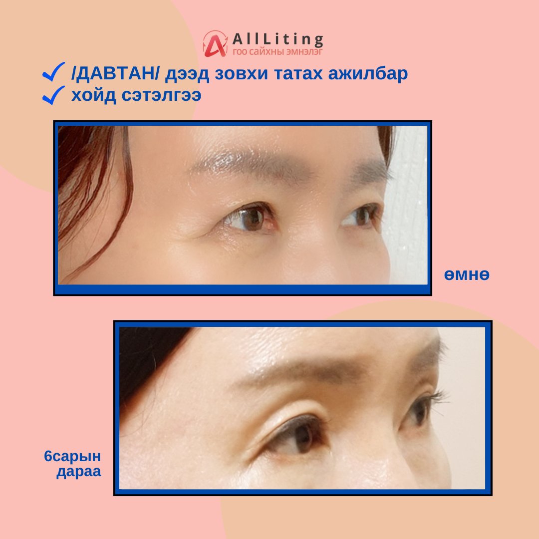 #ДУНД_НАСНЫХНЫ_НҮД_ЗАЛУУЖУУЛАХ_АЖИЛБАР #ALL_Liting
хийлгэсэн ажилбар
📷дээд зовхи татах ажилбар /ДАВТАН МЭС ЗАСАЛ/
📷хойд сэтэлгээ
-------------------------
📷📷 ҮЗЛЭГ/ЗӨВЛӨГӨӨ үнэгүй хийж зөвхөн таньд тохирсон мэс заслын төлөвлөгөөг гаргана.
📷монгол ажилтан: 010-4931-4451