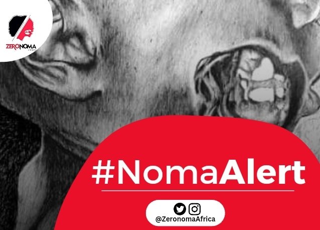 ZeronomaAfrica's tweet photo. Dear @UNICEF_Nigeria,

We've seen increase in #NomaAlert. Just last week, we had two cases (fresh cases). This is an indicator to intensify efforts and synergise across board.

We have some action points and we will like to #collaborate with you for impact.

#ForEveryChild https://t.co/G6kha082lu