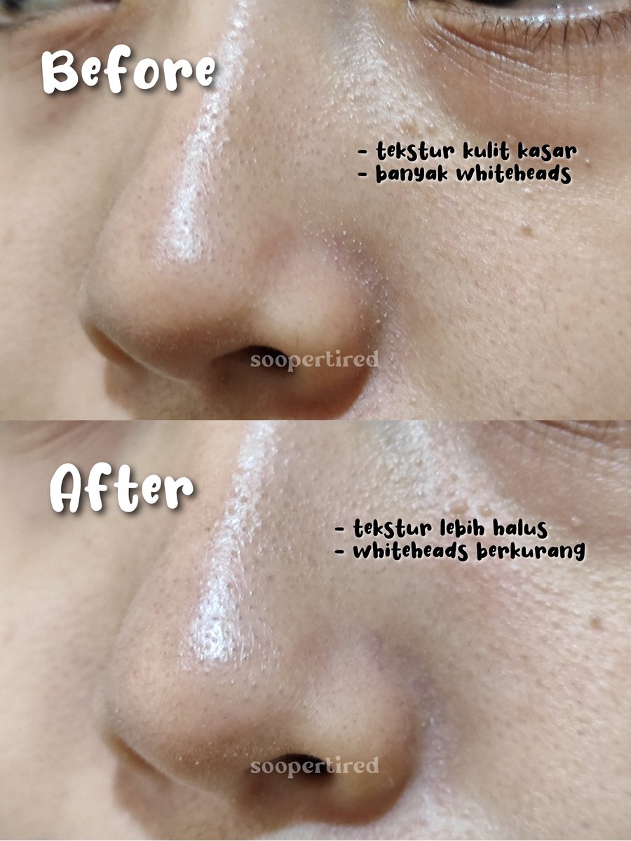 Gak bisa bohong kalo eksfoliasi kulit tuh emg harus banget biar komedo gak menumpuk.

Karena kulitku kering &amp; sensitif, aku agak picky sm produk eksfo krna takut bkin iritasi.

Tapi, produk "home peeling" ini ternyata boleh juga... 👀❤

#racuninskincare