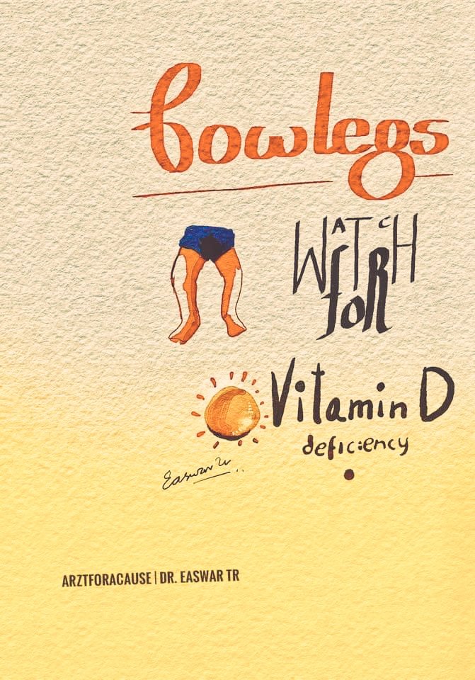 A bit of #calligraphy 
A bit of #art 
A bit of public awareness 
On bowlegs in children 

#rickets 
#bowlegs 
#sunlight 
#vitaminD 
#deformity 
#ArztForACause