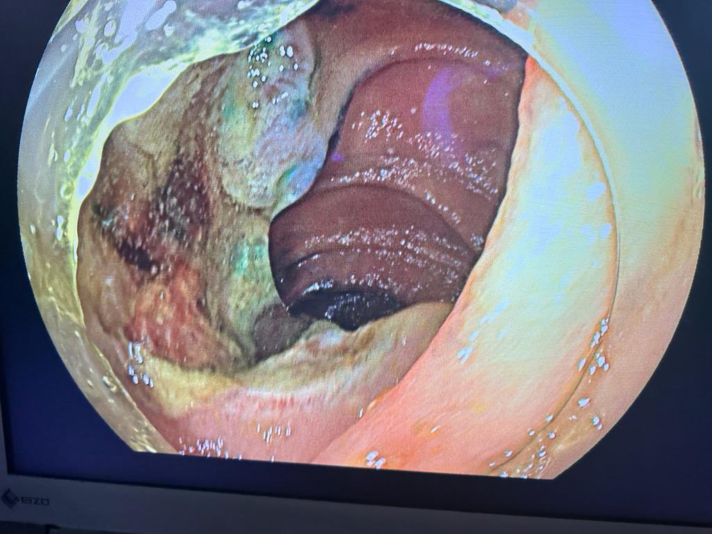 What a great day in the advanced with our new fellow kevin Yeroushalmi MD multiple super complex cases with 5 cm by 4.5 cm rectal polyp ESD in less then 1.5 hours, large 5 cm duodenal adenoma respected with underwater EMR, complex EUS and ERCP’s #interventionalendoscopy