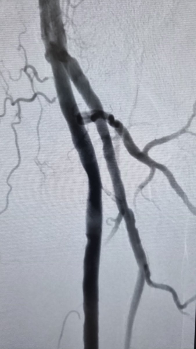 Beautiful results with IVL in a CLTI patient with a proximal SFA high grade calcific stenosis. #limbsalvage #vascular #vascularsurgery #IRad #CLTIfighters #ShockWave