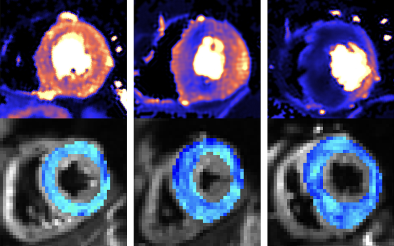 New scanning methods can detect the deadly heart condition hypertrophic cardiomyopathy (HCM) before symptoms appear, according to a new study led by @LuisRLopesDr (@UCL_ICS). Read more ⬇️ bit.ly/44Go8gq