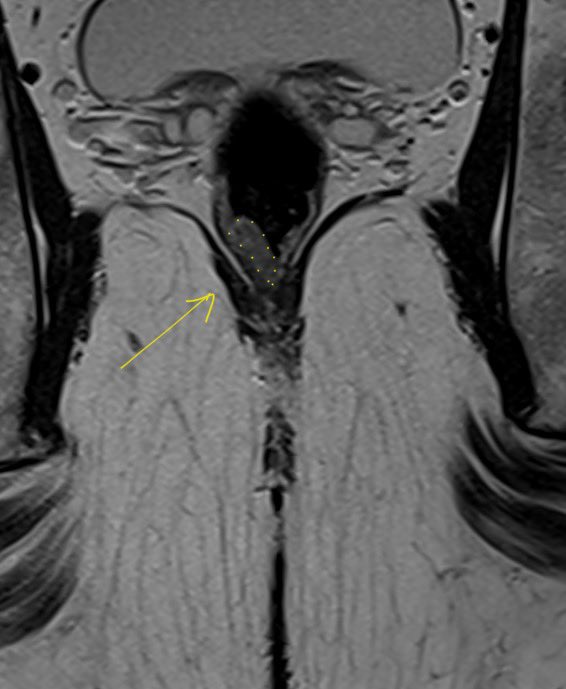 R_Perez_MD's tweet photo. Randomized clinical trial for rectal cancer &amp; organ-preservation in Latam! Consolidation chemo with or without oxaliplatin after nCRT? Primary endpoint: cCR at 18wks!!
Recruitment taking off!!
Interested? New centers are welcome!! https://t.co/7Zag8LvByv