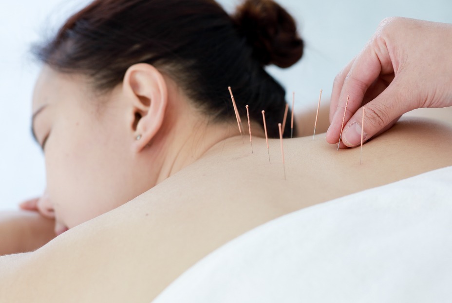 Have you ever tried acupuncture for your #migraine?Did it help? There is some evidence suggesting acupuncture can help to prevent migraine. Find out more here 👇migrainetrust.org/live-with-migr…