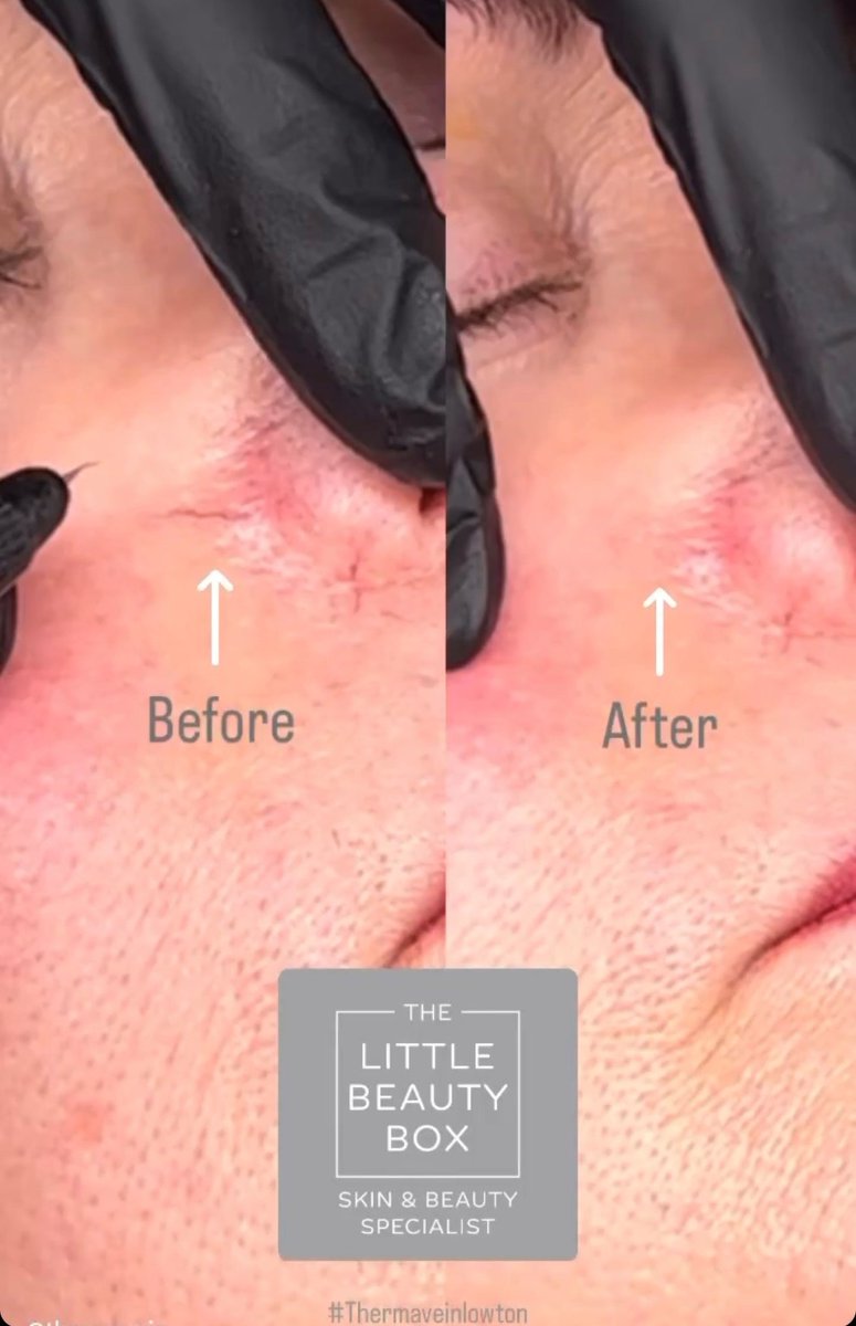 thermavein's tweet photo. ThermaVein is a treatment that gives clients the 'wow factor'. In minutes, thread veins are gone!
For more info or a demo of the device, email info@thermavein.com
#thermavein #threadveins #redveins #spiderveins #facialveins #aesthetics #beauty #IPL #laser
@BeautyBoxLowton https://t.co/LMgZl47a2I