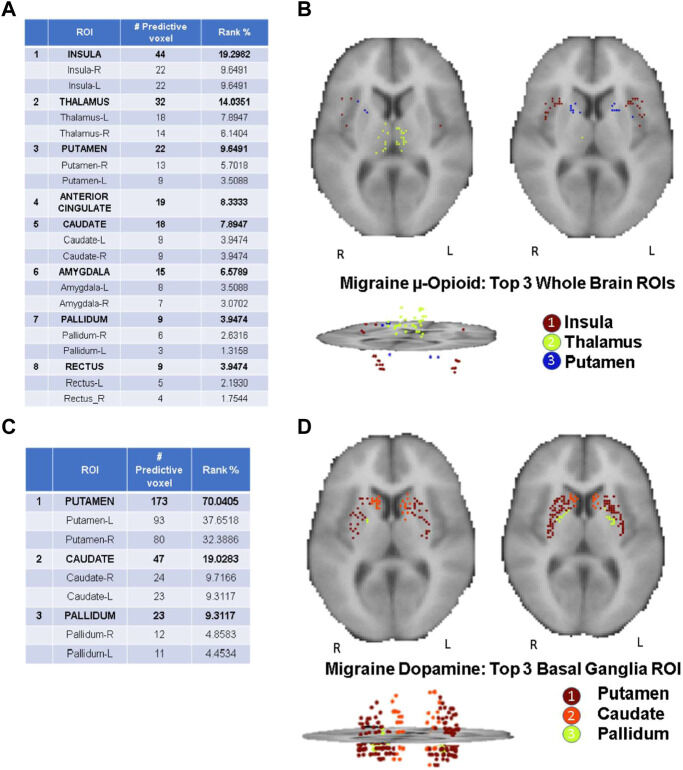 DrAlexDaSilva's tweet photo. Proud of our recent #UMich H.O.P.E. Lab article classifying #migraine patients with a novel machine learning method based on their #opioid &amp; #dopamine profiles, the most critical neurotransmitters in the brain for #pain perception &amp; motivational interface. https://t.co/M1rcKjgMgV https://t.co/KBoRfchp3I