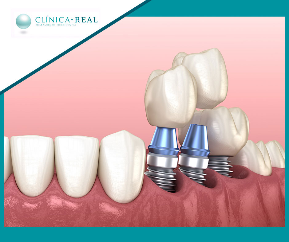 Los #ImplantesDentales son la mejor solución frente a la perdida de un diente, ya que gracias a ellos podrás lucir una sonrisa deslumbrante este #verano 😁☀

En <a href="/clinica_real/">CLINICA REAL</a> podemos ayudarte con nuestro servicio de #implantología en Ciudad Real.