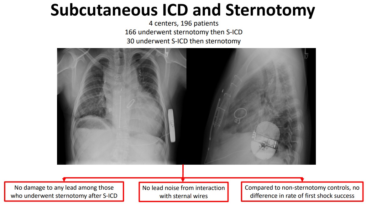 CirculationEP's tweet photo. Does prior sternotomy influence S-ICD functionality? Does CT surgery with pre-existing S-ICD place lead at risk? You might be surprised by what @PennCardiology researchers found through a multi-institutional investigation #AHAJournals #Epeeps https://t.co/lrdhLKSHIu https://t.co/igiMLk2zCh