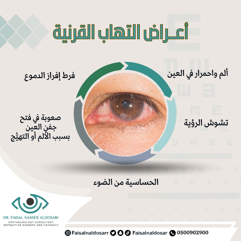 #التهاب_القرنية (Keratitis) هو حالة شائعة يحدث فيها التهاب في قرنية #العين نتيجة التعرض لعدوى أو إصابة في العين، يتسم التهاب القرنية بألم شديد في العين واحمرارها وقد يؤدي إهمال علاجه إلى الإصابة بمضاعفات خطيرة.