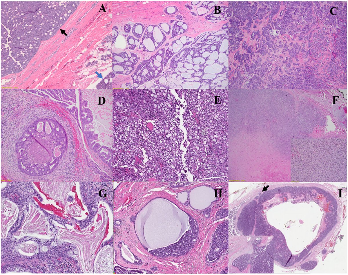 CACancerJournal's tweet image. This new review article highlights standards of care as well as exciting new research for salivary gland cancers that will strive for better patient outcomes.  acsjournals.onlinelibrary.wiley.com/doi/full/10.33…

@ConorSteuerMD
@HeadNeckMD
@JamesBatesMD
@AlanHoMDPhD
@DrNabilSaba
@winshipatemory