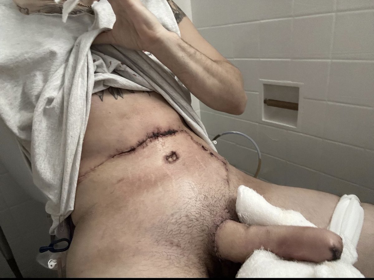 sappholives83's tweet photo. I think this is the most horrific trans surgical result Iโve ever seen in my life. Her โdickโ has hair on it, ffs. This looks like something a Nazi doctor would do to a concentration camp victim, not something a reputable surgeon would do to a willing patient.
#phallo
#trans
#transcult