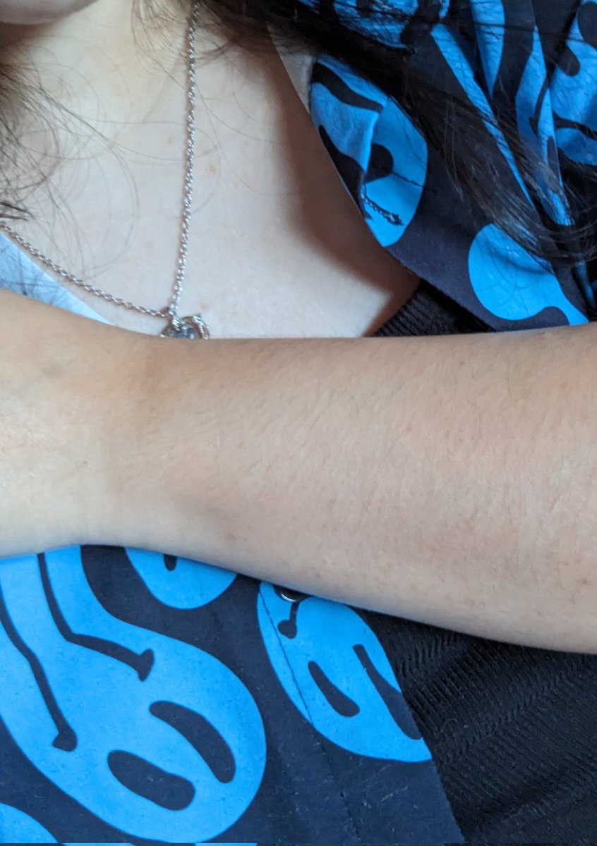 still thinking abt the difference between my arm and chest (the right arm that got burnt in Mexico LMAO) https://t.co/caPV133O1u