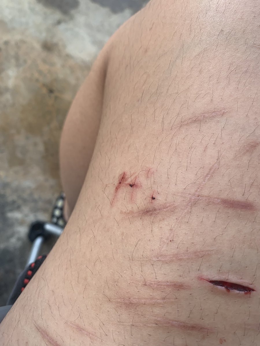 ChavezCristani's tweet photo. Hi :) #cut #blood #hi https://t.co/pvOUllRXsv