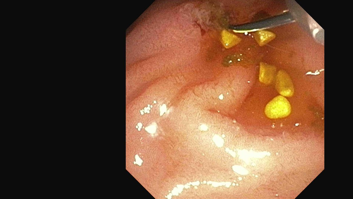 Douglas G. Adler MD, FASGE, FACG, AGAF tweet media