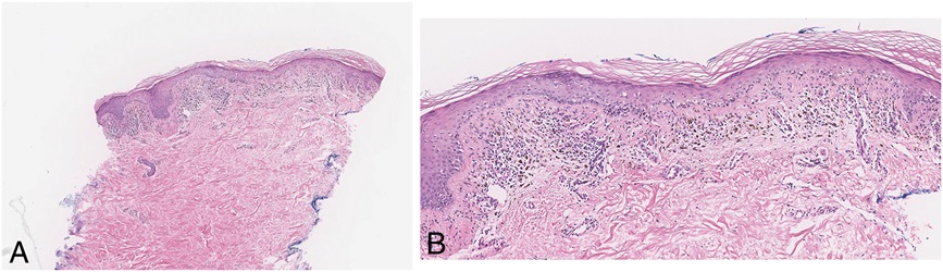 Extraordinary case report - 72yM with a 5-year history of progressive, widespread poikilodermatous patches and thin plaques on the upper back and both legs journals.lww.com/amjdermatopath… #pathology #pathtwitter #dermpath #IntSocDermpath #cutaneouspathology #dermatology #dermtwitter