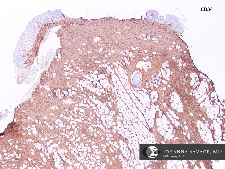 DFSP of the vulva - an uncommon location. These are low-to-intermediate grade sarcomas that are locally aggressive and often recur.  Mainstay of treatment is surgery. Metastasis is rare.  CD34+, S100-, Desmin-, SMA-, CK-, STAT6-

#vulva #pathtwitter #gynpath #dermpath #BSTPath