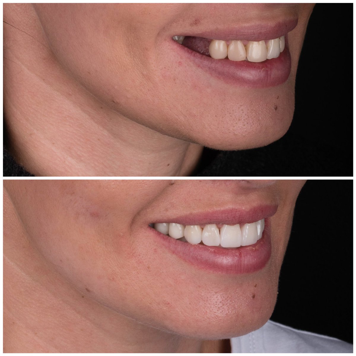 Dental implant magic!
Nobody wants a gap in their smile!
#gap #DentalImplants #jjsdentistry #drjj