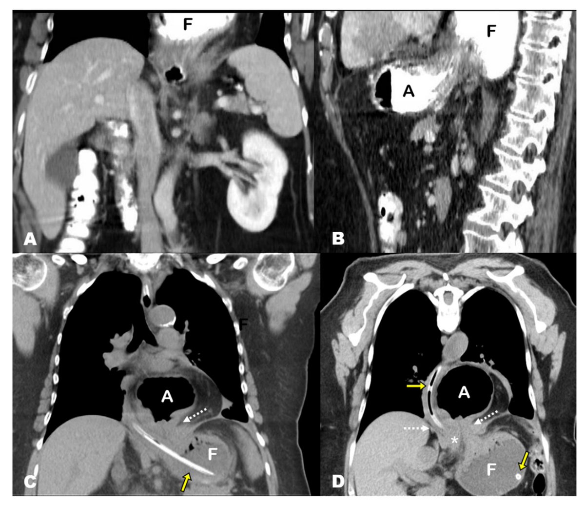 Tomography_MDPI's tweet image. 🥳It's related to everyone.
‘Back-and-Forth Stomach’ #CT #Imaging Findings of a #Pathophysiologic Entity Causing Acute #Gastric Volvulus By Dr. Ramos-Bossini, et al.
#radiology #tomography #imaging
@hospital_hvn @HospInfantaMarg @MDPIOpenAccess 
mdpi.com/2379-139X/8/1/…