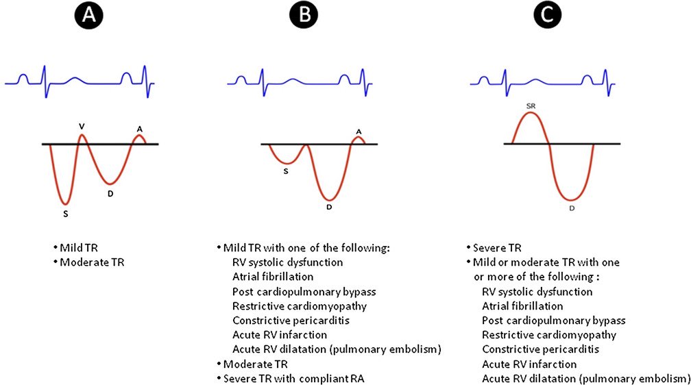 NephroP's tweet image. Various hepatic vein Doppler patterns observed in the setting of tricuspid regurgitation.
#VExUS #POCUS #MedEd #Nephpearls 
🔗 onlinelibrary.wiley.com/doi/full/10.11…