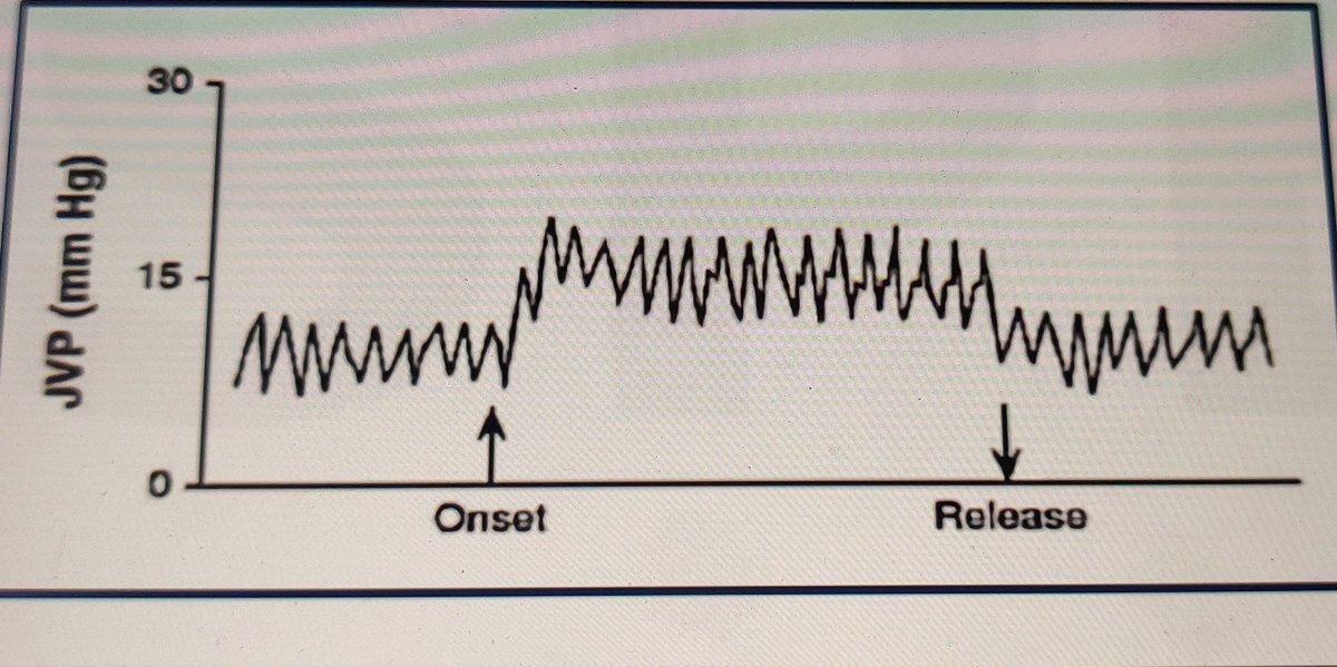 #neetss #Cardiology Abdominojugular reflex predicts heart failure and indicate pulmonary artery wedge pressure is more than 15 mm Hg.